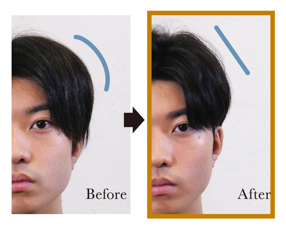 サイド部分のビフォアアフター